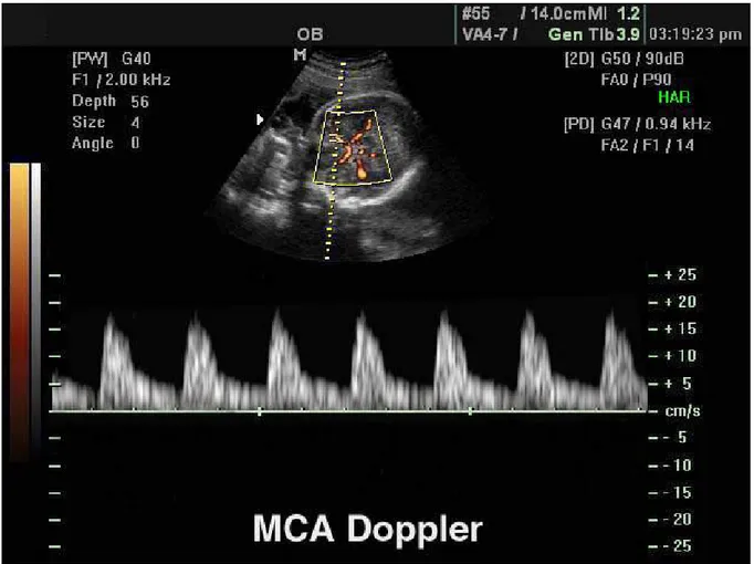 Figure 6: Middle cerebral artery, PW, power Doppler. Ultrasound image.