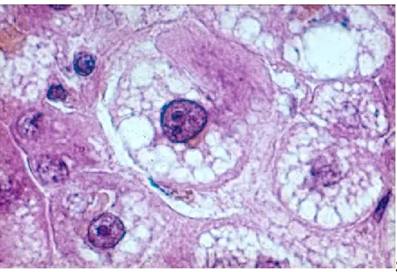 Figure 8 : stéatose hepatique gravidique : le noyau reste au centre de l’hépatocyte et  n’est pas refoulé par la stéatose micro vacuolaire.[39] 