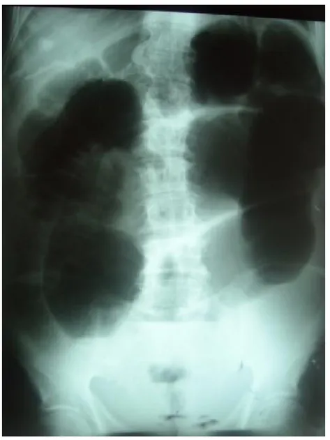 Fig. 9  ASP debout, fait chez un de nos malades, montrant une image en arceau avec  dilatation colique importante