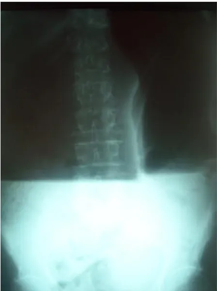 Fig. 10  ASP debout, fait chez un de nos patients, montrant une dilatation colique  monstrueuse