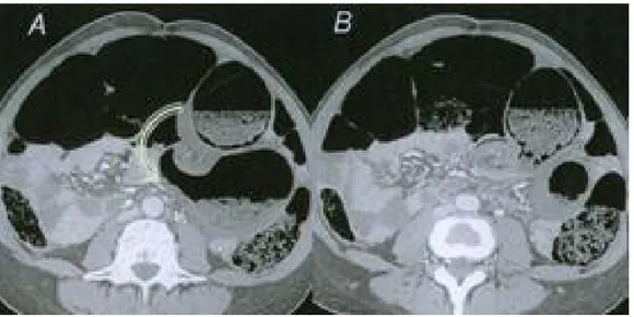 Fig. 13  Coupes TDM axiales passant par la spire de torsion d’un volvulus du  sigmoïde [113]