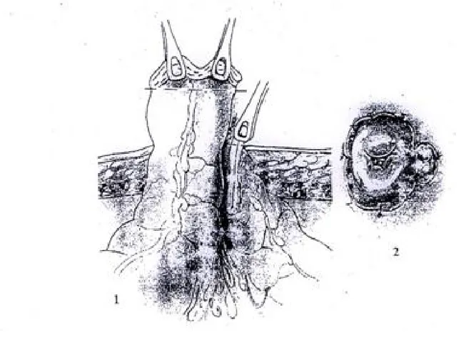 Fig. 15  Colostomie de type Bouilly Volkmann. 