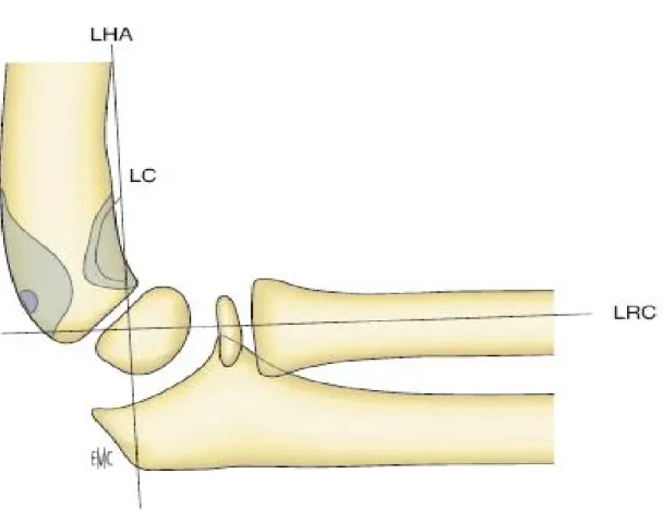 Figure 2: LHA : la ligne humérale antérieure. LRC : ligne radio-capitulaire. lC : ligne 