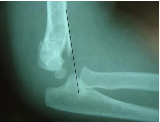 Figure 4: radiographie de profil : la ligne humérale antérieure passe en avant de 