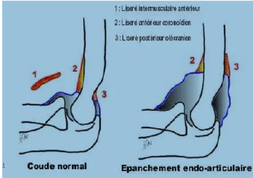 Figure 4 : - coude normale : Aspect normal du coude: liseré coronoïdien (2), liseré 