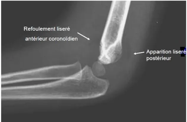 Figure 5 : radiographie du coude montrant le liseré antérieur et postérieur. 