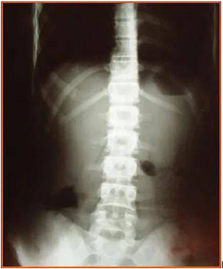 Fig. 13: ASP: Présence de niveaux hydroaériques de type grêlique. 