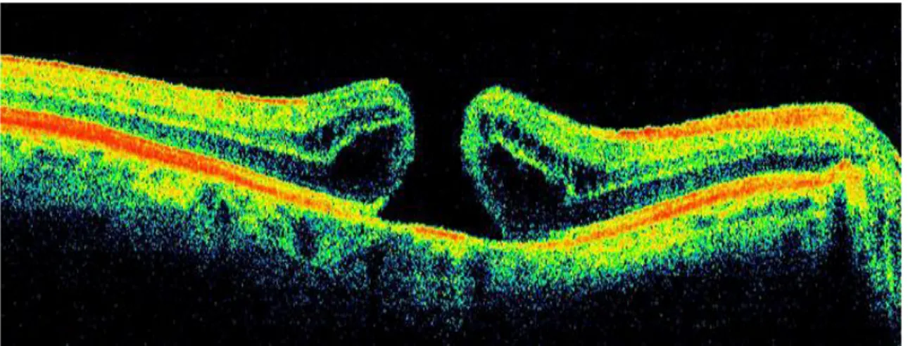 Figure 18 : Image OCT montrant un trou maculaire [42]