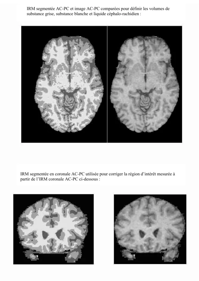 Figure 2.3b : méthodologie pour calculer le volume cérébral total et la région d’intérêt