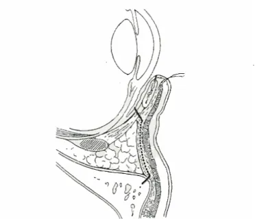 Fig. 11.   Voie d’abord trans-conjonctivale 