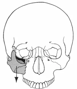 Fig. 3.   Fracture de l’os malaire 