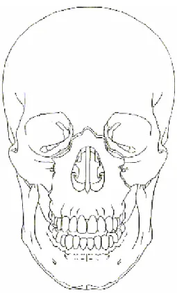 Fig. 4.   Fracture de type Le Fort II 
