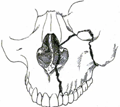 Fig. 5.   Fracture de type Lannelongue ou Converse 