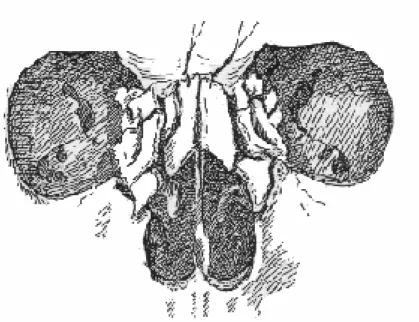 Fig. 6.   Fracture centro-faciale 