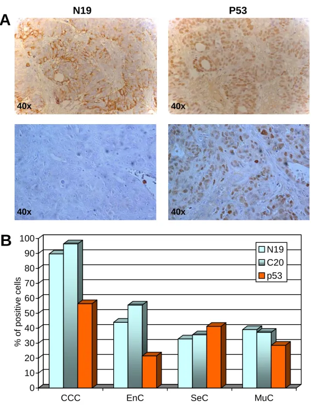 Figure 9.  Comparison of BARD1 (N19 and C20) and p53 expression in ovarian and breast carcinoma