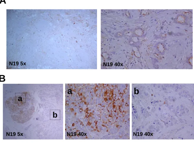 Figure 10. The expression of BARD1 in sporadic breast cancer. BARD1 (N19) staining was less in well 