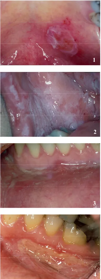 Fig. 1 :  ♀ , 41 ans, brûlure thermique.  