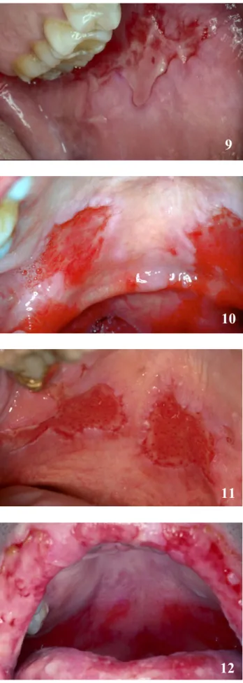 Fig. 9 :  ♂ , 42 ans, pemphigus vulgaire.  