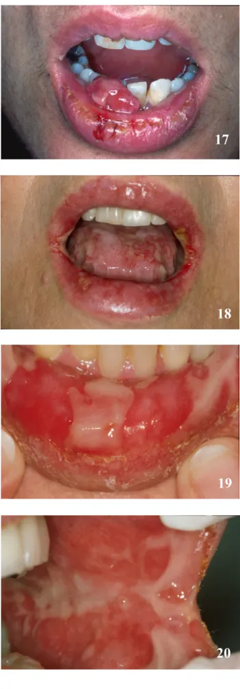 Fig. 17 :  ♂ , 34 ans, pemphigus vulgaire.  