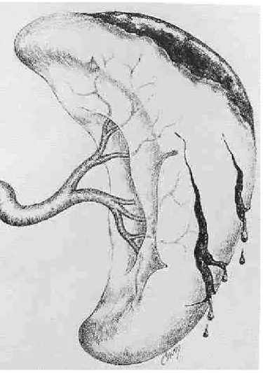 Figure 2. Représentation d’un traumatisme splénique grade 2 selon l’AAST 
