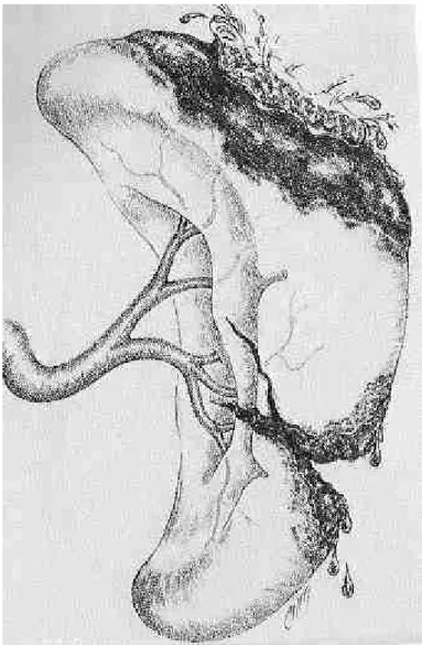 Figure 3. Représentation d’un traumatisme splénique grade 3 selon l’AAST 