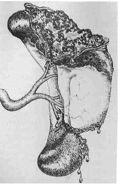 Figure 4. Représentation d’un traumatisme splénique grade 4 selon l’AAST 