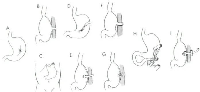 Fig1 : Types de gastrostomie par ordre chronologique d’apparition (1)