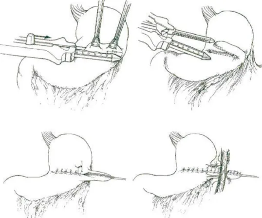 Fig. 2 : Technique de Janeway (2) 