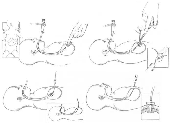 Fig. 6 : Technique de Gauderer : « Pull method » (11) 