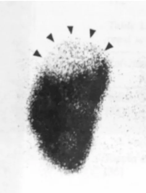 Fig. 2 :  Scintigraphie rénale au DMSA chez un  garcon de 10 mois présentant une infection urinaire  avec état fébrile