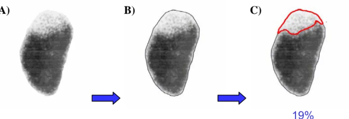 Fig. 1 : Représentation de la première étape : contour du rein et des lésions  A) hypoactivité du pôle supérieur du rein gauche (vue postéro-antérieure)   B) contour du rein gauche   