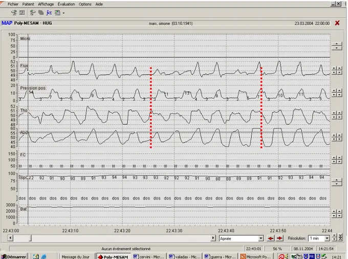 Figure 3. Tracing showing one type of patient-ventilator asynchrony. Delay between the  initiation of patient′s inspiratory effort (dotted vertical line on left) and triggering of ventilator   with an identical respiratory frequency between patient and ven