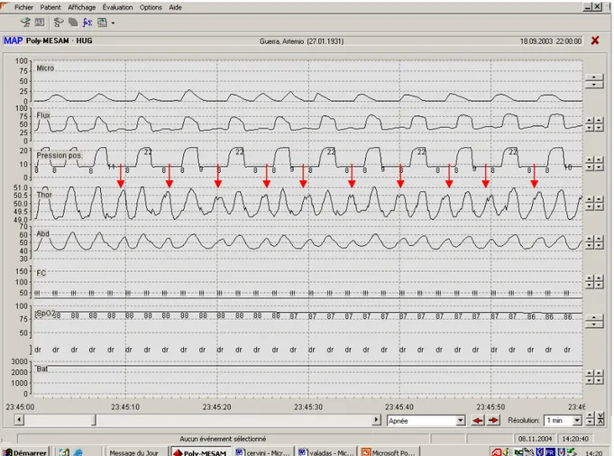 Figure 4. Representative tracing from a patient during patient-ventilator asynchrony. The  patient′s respiratory rate is very high (24-28 breaths per minute); only every second  inspiratory effort by the patient triggers the ventilator and is supported by 