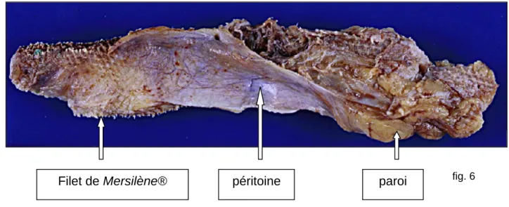 fig. 6  Filet de Mersilène®  péritoine paroi 
