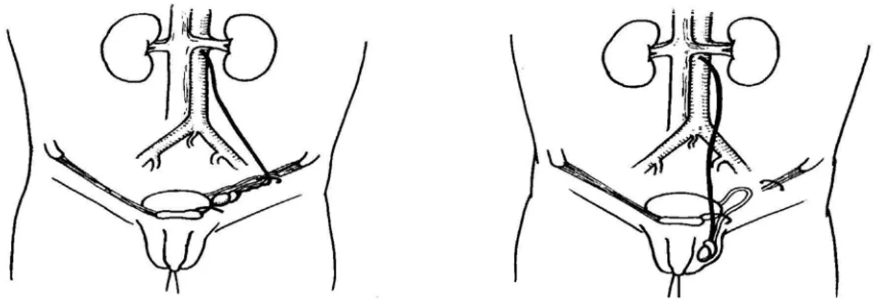 Figure 2: Le trajet de l'artère spermatique est redressé après dissection. Schémas  issus du Précis d’Urologie de l’Enfant, P