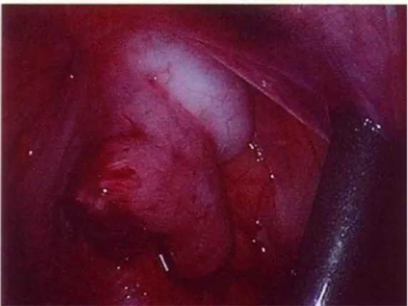 Figure 6 : 1er temps par laparoscopie 