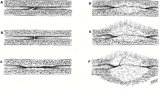 Figure 0: l'anatomie des sténoses (tiré de Blandy &amp; Folwer’s urology, 2 nd edition, 1996, page 2986) 