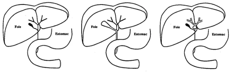 Figure 6 : Différent type d’AVB (131)