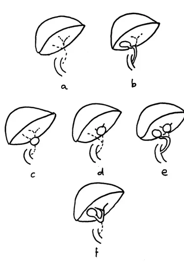 Figure 7: différentes formes anatomiques d’AVB (136)  a: atrésie complète 