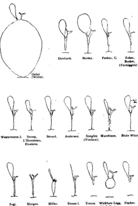 Figure 1 : Différent type d’atrésies selon Holmes. (14 ) 