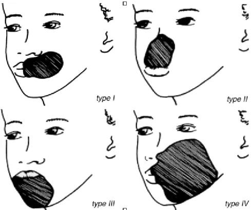 Figure 1 :  Classification des séquelles de noma. 