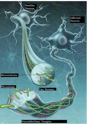 Figure  12shows  the  example  of  a  healthy  neuron  and  an  affected  neuron  clearly  showing  the  presence of neurofibrillary tangles associated with 