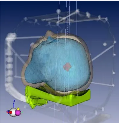 Figure  5.3 : Représentation  dans  l’espace  3D  obtenue  dans  l’interface  graphique  d’Isogray  de  la  structure  externe (gris), de la surface érodée du fantôme tête (bleu) et du premier PTV exploré dans l’étude statique  (rouge)