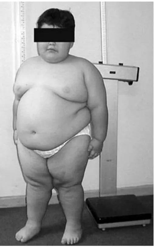 Figure 2.14: Eight-year-old with PWS: Note presence of morbid obesity [ 29 ].