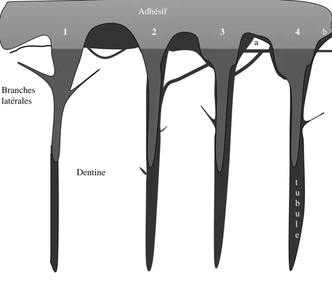 Figure 1 : les différents types de microperméabilité du fluide pulpaire au niveau d’une  interface dentinaire adhésive [112] 
