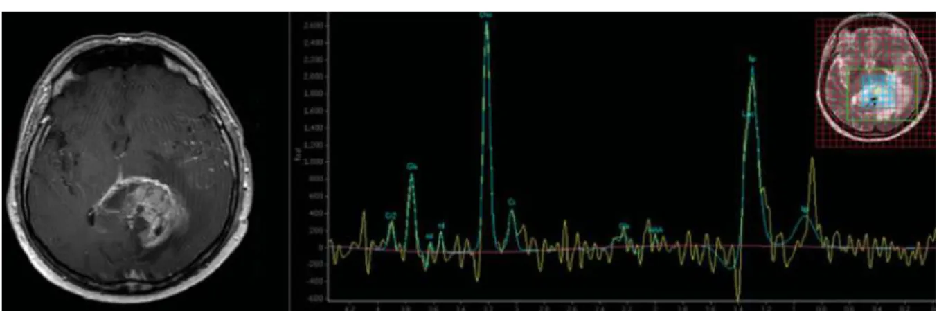Figure 8 : Imagerie de Spectroscopie par Résonance Magnétique réalisée chez un patient atteint de GBM