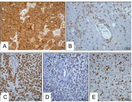 Figure 13 : Exemple de résultats immunohistochimiques obtenus pour un  GBM  canin  (A :  Marquage  nestin,  B :  Marquage  CD133,  C :  Marquage  Olig2, D : Marquage DCx, E : marquage Ki67)(Fernandez et al., 2016) 