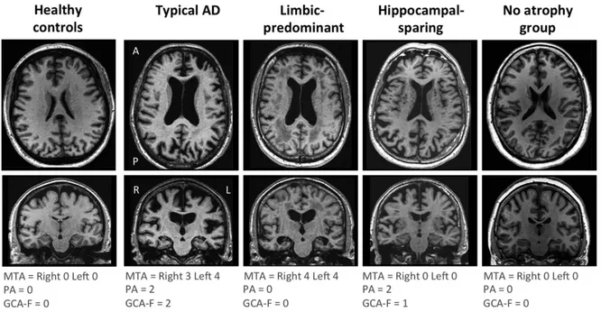Figure 6 : Distinction des différents sous-types de MA basés sur le profil d’atrophie cérébrale à partir  d’échelles d’atrophie (d'après Ferreira et al., 2017) 