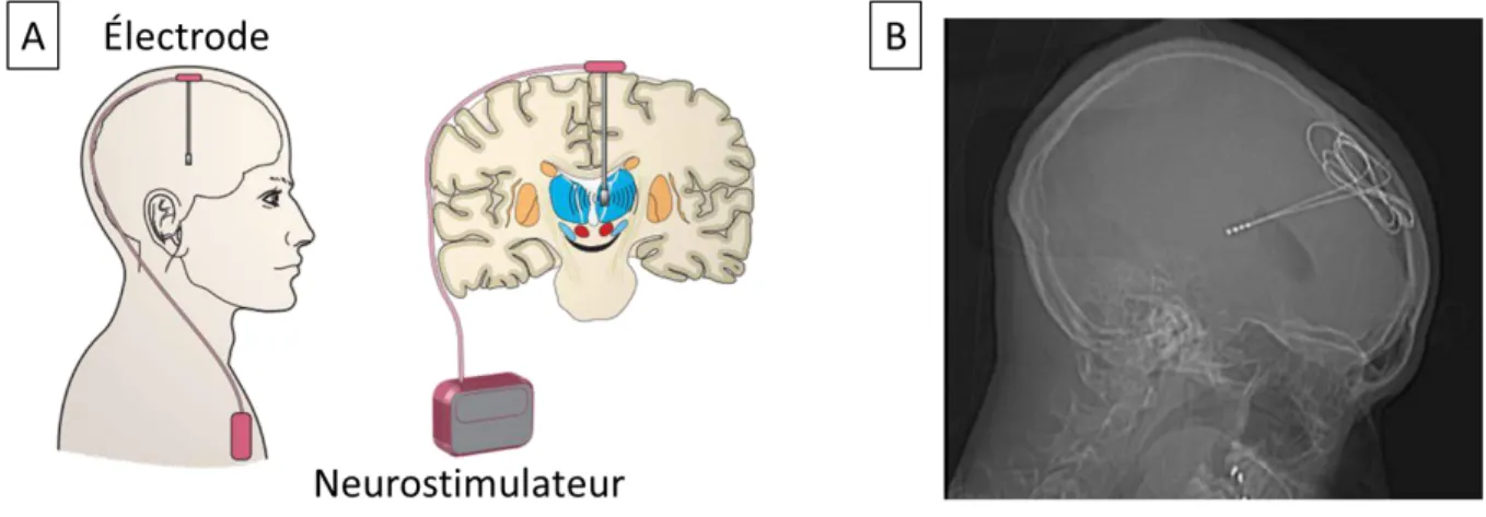 Figure 7 – Illustration d’un système de neuromodulation. (A) Schéma du stimulateur relié à une  électrode profonde de stimulation