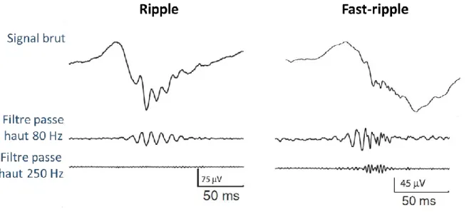Figure 20 – HFOs. Illustrations d’un ripple (à gauche) et d’un fast-ripple (à droite) apparaissant  pendant des pointes intercritiques